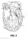 Fig. 04 - Devices for remodeling a valve annulus and ventricle