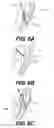Fig. 09 - Devices for remodeling a valve annulus and ventricle