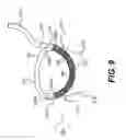 Fig. 10 - Devices for remodeling a valve annulus and ventricle