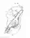 Fig. 13 - Soft tissue anchors and implantation techniques