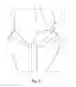 Fig. 06 - A Medical Device And Method For Facilitating Selection Of An Annuloplasty Implant