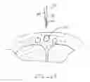 Fig. 09 - Devices and methods for reshaping blood vessels