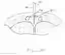 Fig. 10 - Devices and methods for reshaping blood vessels