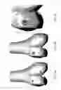 Fig. 11 - SYSTEM AND METHOD FOR THREE DIMENSIONAL PRINTED IMPLANTATION GUIDES