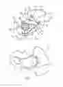 Fig. 04 - Endoprosthesis for the partial replacement of the human pelvic bone