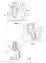 Fig. 05 - SUPPORT DEVICE AND METHOD OF USE