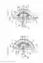 Fig. 02 - Separation of hip joint liner and socket elements