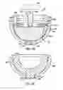 Fig. 05 - Separation of hip joint liner and socket elements