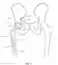 Fig. 02 - Methods and devices for a surgical hip replacement procedure