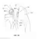 Fig. 14 - Methods and devices for a surgical hip replacement procedure