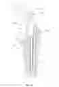 Fig. 16 - Methods and devices for a surgical hip replacement procedure