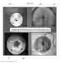 Fig. 08 - PAIN FREE SOCKET SYSTEM AND ASSOCIATED METHOD
