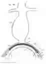 Fig. 08 - Minimization of stent-graft migration during implantation