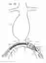 Fig. 09 - Minimization of stent-graft migration during implantation