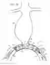 Fig. 10 - Minimization of stent-graft migration during implantation