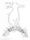 Fig. 12 - Minimization of stent-graft migration during implantation