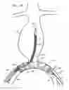 Fig. 13 - Minimization of stent-graft migration during implantation
