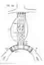 Fig. 16 - Minimization of stent-graft migration during implantation