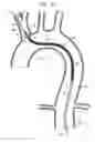 Fig. 19 - Minimization of stent-graft migration during implantation