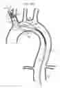 Fig. 20 - Minimization of stent-graft migration during implantation