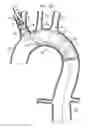 Fig. 22 - Minimization of stent-graft migration during implantation