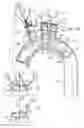 Fig. 23 - Minimization of stent-graft migration during implantation