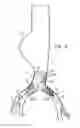 Fig. 25 - Minimization of stent-graft migration during implantation