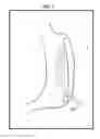Fig. 10 - GASTRIC IMPLANT AND METHOD FOR USE OF SAME