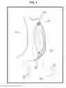 Fig. 12 - GASTRIC IMPLANT AND METHOD FOR USE OF SAME