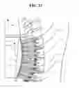 Fig. 12 - Orthopedic support with magnets