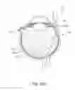 Fig. 22 - Sub-retinal tangential needle catheter guide and introducer