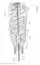 Fig. 45 - Sub-retinal tangential needle catheter guide and introducer