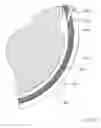 Fig. 77 - Sub-retinal tangential needle catheter guide and introducer