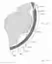 Fig. 80 - Sub-retinal tangential needle catheter guide and introducer