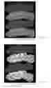 Fig. 43 - Drug delivery means