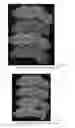 Fig. 44 - Drug delivery means
