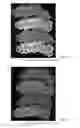 Fig. 45 - Drug delivery means
