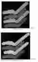 Fig. 57 - Drug delivery means
