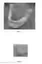 Fig. 02 - ARTIFICIAL BONE FORMS AND COMPOSITIONS FOR APPROXIMATING BONE