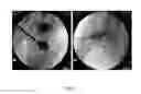 Fig. 03 - Injectable fibrin composition for bone augmentation