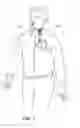 Fig. 02 - MEDICAL SUCTION SYSTEM AND DISPOSABLE CONTAINER