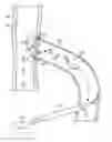 Fig. 01 - Device for promoting fistula patency and method