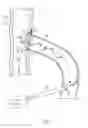 Fig. 04 - Device for promoting fistula patency and method