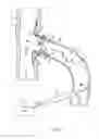 Fig. 05 - Device for forming fistula between blood vessels, and method