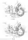Fig. 17 - Occlusion sensing for an infusion pump