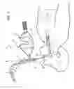 Fig. 02 - DEVICE HAVING MANUAL RESUSCITATION AND SUCTION CAPABILITIES