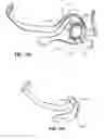Fig. 82 - Patient interface and method for making same