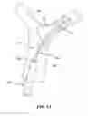 Fig. 09 - Retraction and aspiration device for treating embolism and associated systems and methods