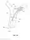 Fig. 10 - Retraction and aspiration device for treating embolism and associated systems and methods