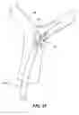 Fig. 14 - Retraction and aspiration device for treating embolism and associated systems and methods